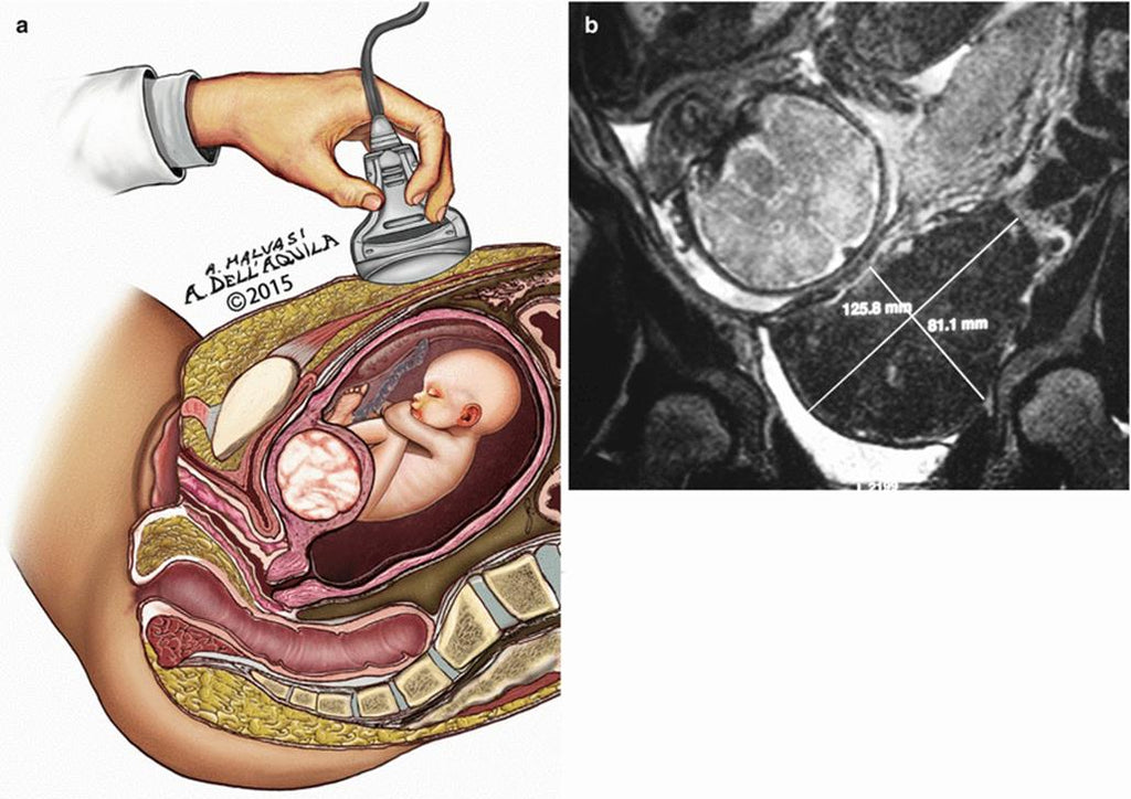 Fibroids and Pregnancy